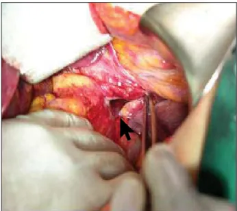 Fig. 3. Intra-operative  images  revealing  diaphragmatic  defect  (arrow).    주소:  상복부 통증    현병력:  평소 특별한 기저질환 없이 지내오던 환자로 3일 전부터 발생한 상복부 통증으로 응급실에 내원하였다