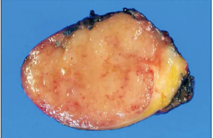 Fig. 4. The lymph node in the specimen measured 3.3×3.0×2.2 cm and weighed 12.7 g.