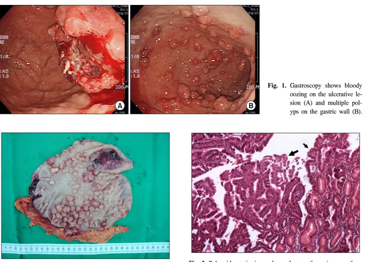 Fig.  1.  Gastroscopy  shows  bloody  oozing  on  the  ulcerative   le-sion  (A)  and  multiple   pol-yps  on  the  gastric  wall  (B).