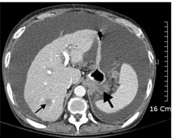 Fig.  5.  Abdominal  CT  shows  recurred  cancer  or  conglomerated  metastatic  lymphadenopathy  (about  5  cm  in  size)  at  the  anastomosis  site,  mild  splenomegaly  (about  13  cm),  liver  metastasis  and  diffuse  massive  ascites  with  mesenter