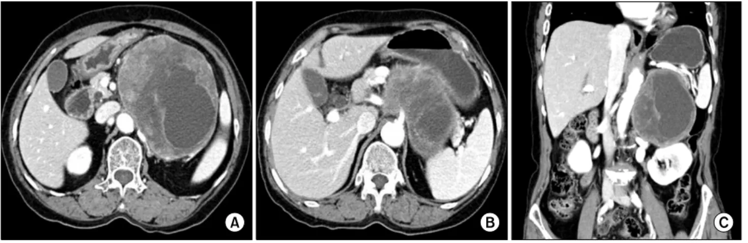 Fig. 1. Abdominal CT findings. The image shows a 12×10 cm sized retroperitoneal tumor (A)