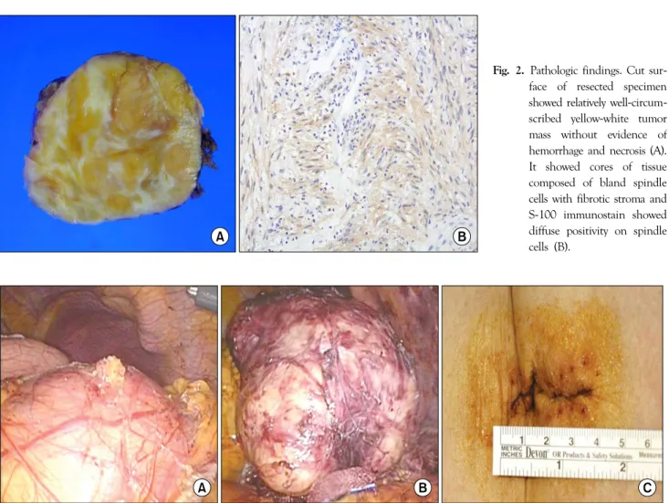 Fig. 2. Pathologic findings. Cut sur- sur-face of resected specimen  showed relatively  well-circum-scribed yellow-white tumor  mass without evidence of  hemorrhage and necrosis (A).