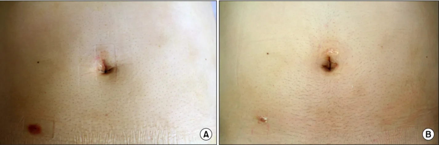 Fig.  2.  (A)  Postoperative  view,  1  day  after  operation  in  Group  1.  (B)  Postoperative  view,  7  days  after  operation  in  Group  1.