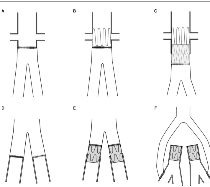 Fig. 3. Proximal (A∼C) and distal (D∼F) anastomotic modes of open conversion.