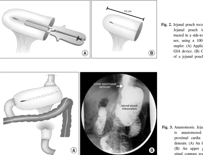 Fig.  2.  Jejunal  pouch  reconstruction. 