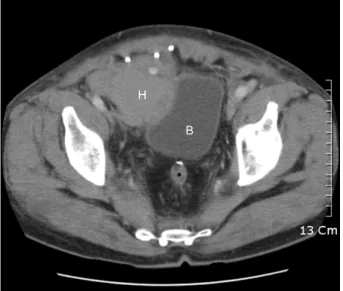 Fig.  2.  A  case  of  mesh  infection.  solid  line  =  a  sinus  tract;  dotted  line  =  infected  mesh.