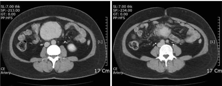 Fig. 1. Abdominal  CT  finding.  7×8  cm  sized  low-attenuating  mass  is  visible  in  the  small  bowel  mesentery