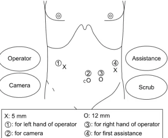 Fig.  1.  Placement  of  trocars  for  laparoscopic  central  pancreatectomy. 투관침(trocar)을 삽입하였고,  이산화탄소(CO 2 )를 이용하여  12  mmHg의 압력으로 기복강을 유지하였다