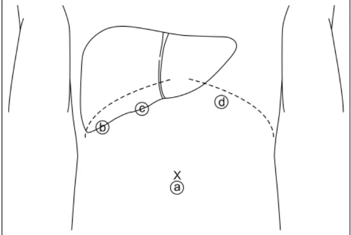 Fig.  1.  Location  of  the  ports  for  laparoscopic  left  hepatectomy.제까지11-15  발전하였다