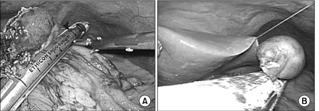 Fig.  1.  (A)  Laparoscopic  resection  for  endophytic  submucosal  resection  using  eversion   tech-nique
