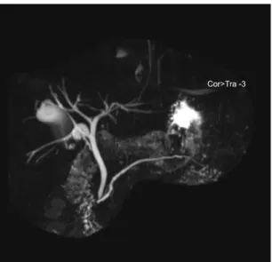 Fig.  1.  3D-MIP  reconstruction  MRCP  image  showing  non-dilated  CBD  in  diameter  with  signal  void  stones  at  the  end.