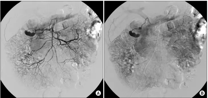 Fig. 2. Selective angiogram of superior mesenteric artery (SMA). (A) On angiogram obtained by cannulating SMA, the right gastroepiploic artery is arising from SMA and has a large fusiform aneurysm