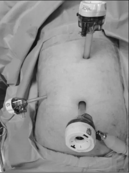 Fig.  1.  The  locations  of  trochars  in  abdominal  wall.