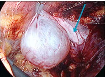 Fig.  3.  Round  ligament  cyst  just  lateral  to  opened  sac  (arrow)  of  hernia  81예중  9예(11.1%)에서  자궁  원인대  낭종이  발견되었고 (Fig