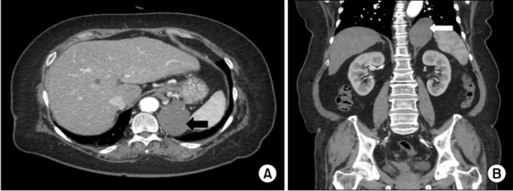 Fig.  1.  Abdominal  computed  tomo- tomo-graphy  scan.  (A)  Axial  CT  finding.  There  is  a  8  cm  sized  cystic  mass  with  calcifications  and  peripheral  enhancement  in  the  left  retroperitoneal  space  (black  arrow)