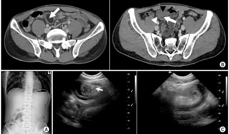 Fig. 1. (A) The plain abdominal films show the localized ileus in the lower abdomen. (B) The contrast-enhanced CT scan demonstrates an ileo-ileal intussusception caused by a mass of the ileum