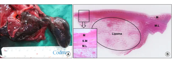 Fig. 2. Gross and microscopic findings of the specimen. (A) Photograph of the resected ileum shows a pedunculated polypoid mass, measuring  4×3×2 cm, as the lead point of the intussusception