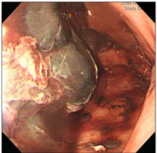 Fig.  1.  Abdominal  CT  scan  showed  intraluminal  hematoma  in  the  remnant  stomach  with  excessive  fibrosis  at  previous   oper-ated  portion.