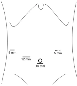 Fig.  1.  A  schematic  illustration  of  the  trocar  placement.  A  10-mm  trocar  is  inserted  through  a  subumbilical  incision  and  two  other  trocars  were  placed  under  laparoscopic  guidance