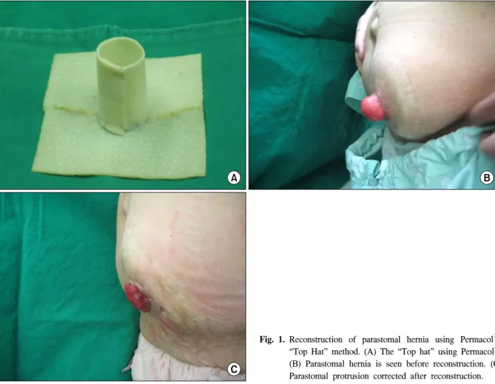 Fig. 1. Reconstruction  of  parastomal  hernia  using  Permacol Ⓡ - 