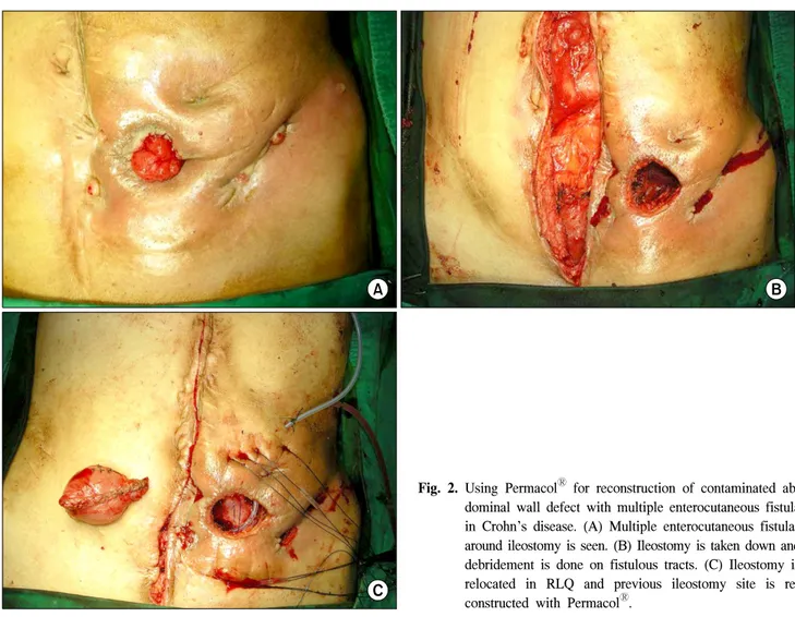 Fig. 2. Using  Permacol Ⓡ   for  reconstruction  of  contaminated  ab- ab-dominal  wall  defect  with  multiple  enterocutaneous  fistula  in  Crohn’s  disease