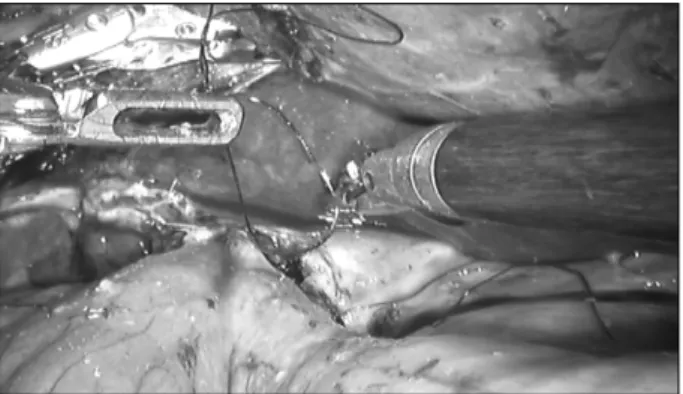 Fig.  4.  Photograph  of  the  hepaticojejunostomy.
