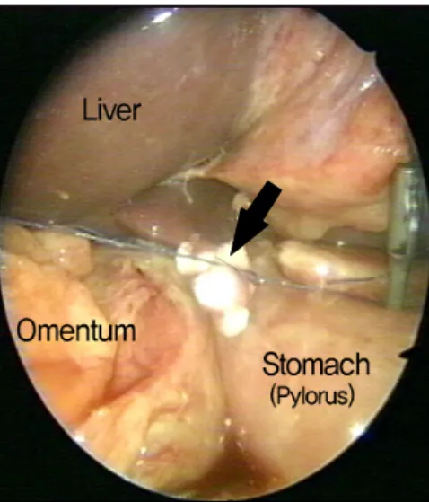 Fig.  1.  Intraoperative  finding  of  simple  closure  with  gelatin  sponge  patch  (black  arrow)  instead  of  omentum.
