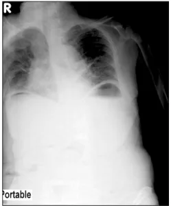 Fig.  1.  Chest  x-ray  revealed  free  air  in  both  subphrenic  spaces.