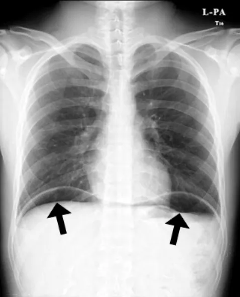 Fig. 2. Abdomen computed tomography scan shows the findings of  pneumoperitoneum (arrows).