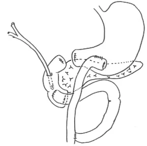 Fig. 5. Operative management. Duodenal diverticulization is  performed with the duodenal resection of the 1st, 3rd, 4th parts