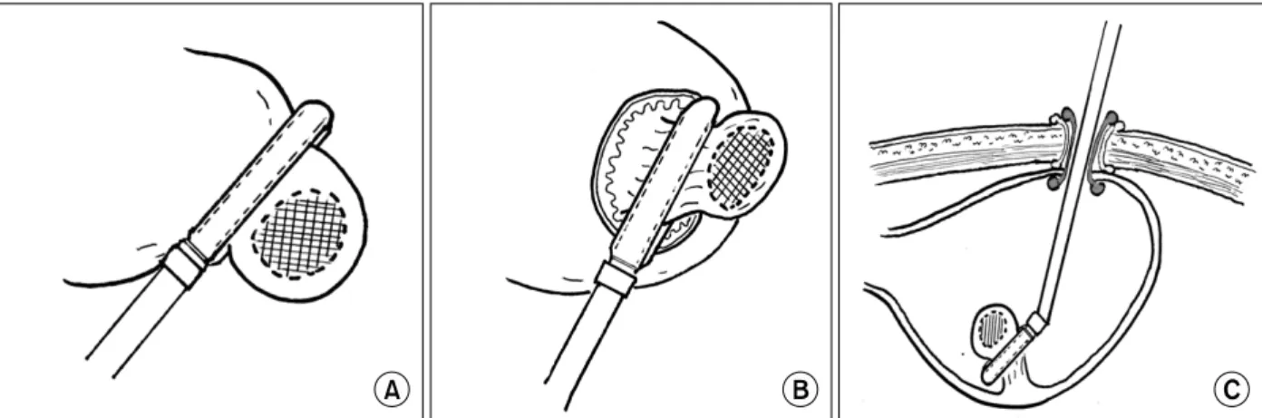 Fig. 1. Schematic  drawings  of  laparoscopic  gastric  wedge  resection.  (A)  Exogastric  resection