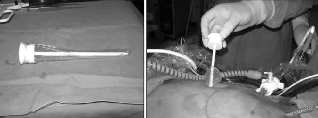 Fig.  1.  2  mm  trocar  insertion  state  on  suprapubic  lesion.