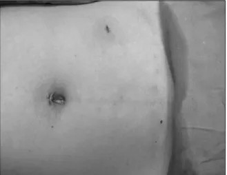 Fig. 3. Post-op  wound  (supra-umbilicus  &amp;  LLQ  using  5  mm  trocar,  suprapubic  using  2  mm  trocar).