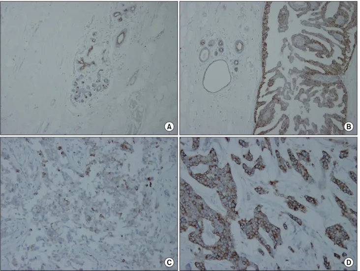 Table  1.  Cox-2  expression  in  the  intraductal  and  invasive  ductal  carcinomas No