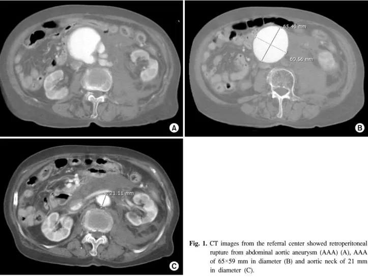 Fig.  1.  CT  images  from  the  referral  center  showed  retroperitoneal  rupture  from  abdominal  aortic  aneurysm  (AAA)  (A),  AAA  of  65×59  mm  in  diameter  (B)  and  aortic  neck  of  21  mm  in  diameter  (C).
