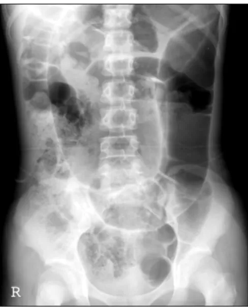 Fig.  1.  Plain  abdominal  film,  showing  ‘coffee  bean’  shaped  dis- dis-tension  of  sigmoid  colon.
