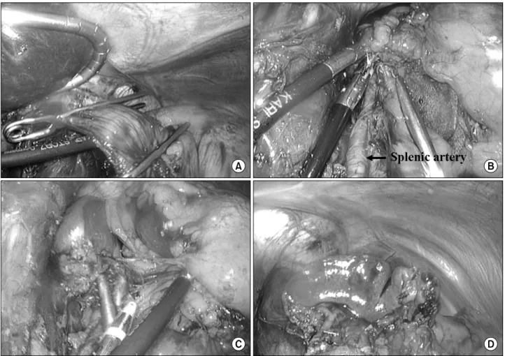 Fig.  1.  Operative  fields  in  the  Downstream  procedure.  (A)  Distal  esophagus  was  clamped  with  endo-vascular  clamps