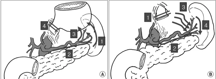 Fig.  2.  Schematic  diagrams  of  each  operative  procedure  in  the  laparoscopic  assisted  total  gastrectomy