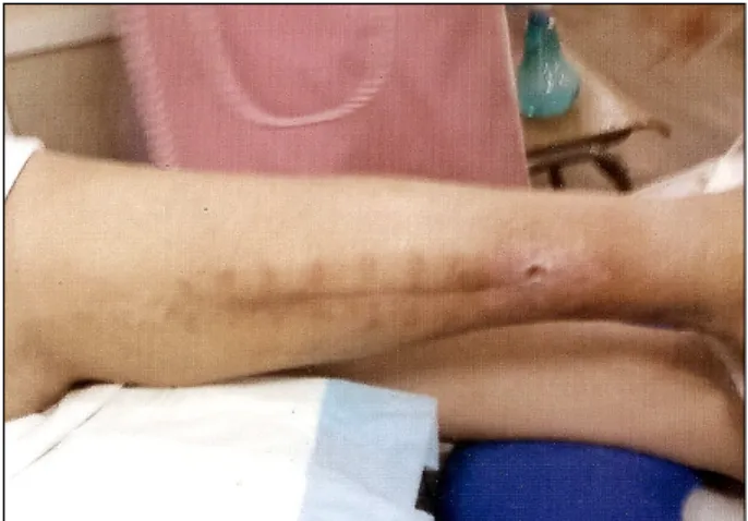 Fig.  2.  Final  state  of  fasciotomy  wound.  The  complicated  fas- fas-ciotomy  wound  can  be  closed  successfully.