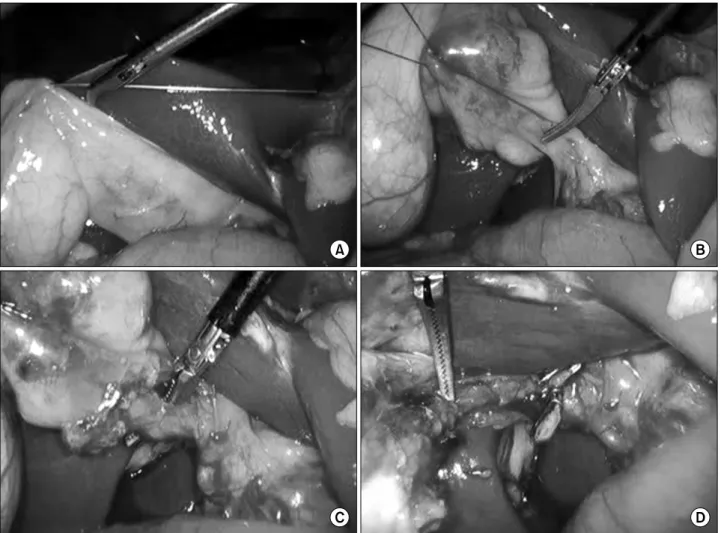 Fig.  1.  Immediate  post-operative  view  of  the  patient  after  2-trocar  method  of  laparoscopic  cholecystectomy.