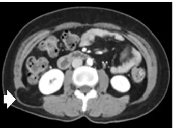 Fig.  5.  Abdominal  CT,  5  months  later  after  operation,  reveals  resolution  of  the  hernia  defect.