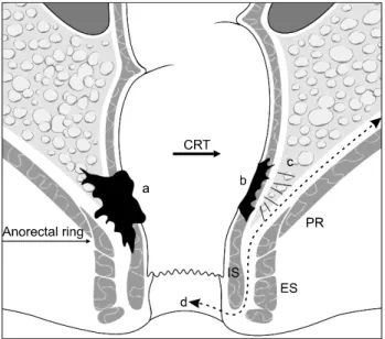 Fig.  1.  Scheme  of  intersphincteric  resection  for  distal  rectal  cancer  using  concurrenct  chemoradiotherapy