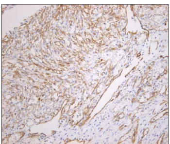 Fig.  6.  The  spindle  tumor  cells  are  diffusely  reactive  for  CD34  antibody  on  immunohistochemical  stain  (ABC  method, 