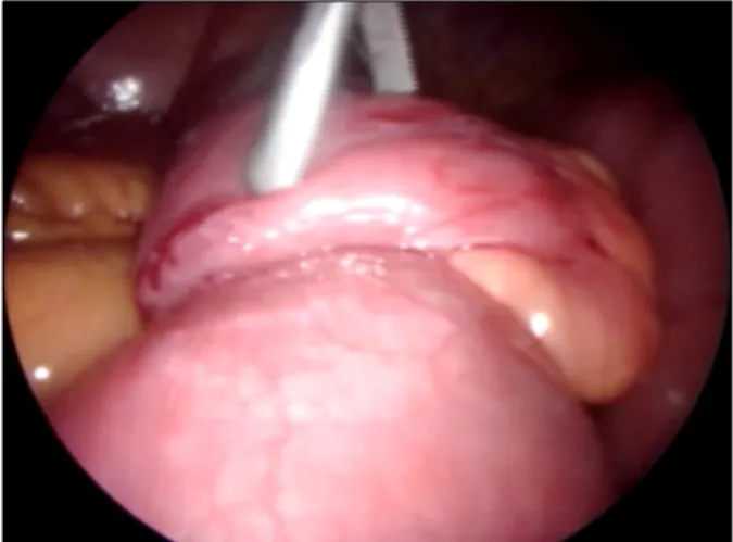 Fig. 3. Gross  finding  of  the  specimen:  a  well  defined  polypoid  firm  mass  (5×3.5×2.5  cm).