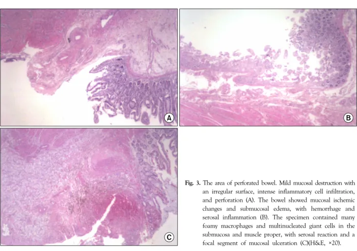 Fig. 3. The area of perforated bowel. Mild mucosal destruction with  an irregular surface, intense inflammatory cell infiltration,  and perforation (A)