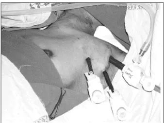Fig.  1.  The  patient's  position  for  endoscopic  thyroidectomy  by  axillary  approach.