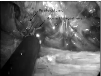 Fig.  4.  The  contralateral  lobe  was  tracted  by  the  grasp  forcep  and  reseccted  by  harmonic  scalpel.