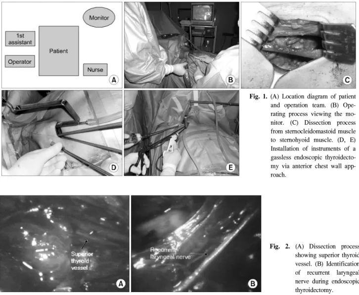 Fig. 1. (A) Location diagram of patient and operation team. (B)  Ope-rating process viewing the  mo-nitor