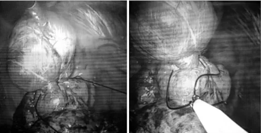 Fig. 1. Double ligation of endo- endo-loop at the giant bullae.