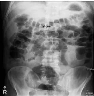 Fig. 1. Simple Abdomen. Incarcerated stone and broken wire are visible.